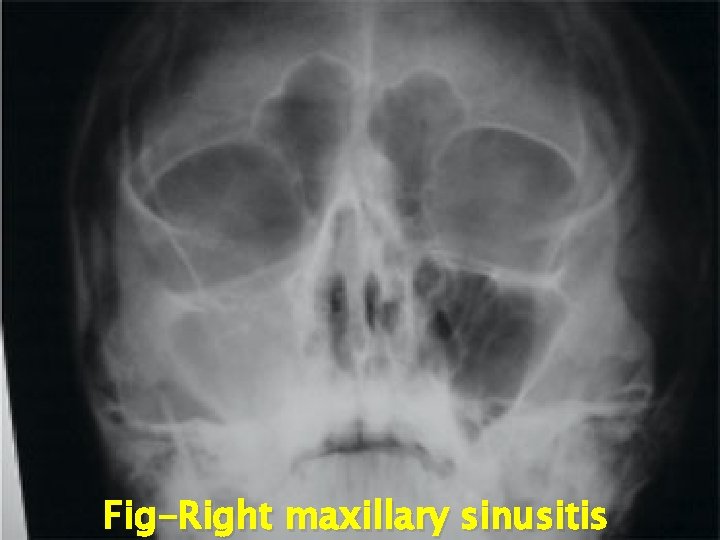 Fig-Right maxillary sinusitis 