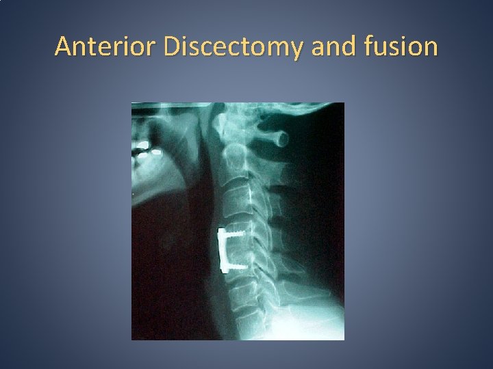Anterior Discectomy and fusion Anterior Discectomy and fusion
