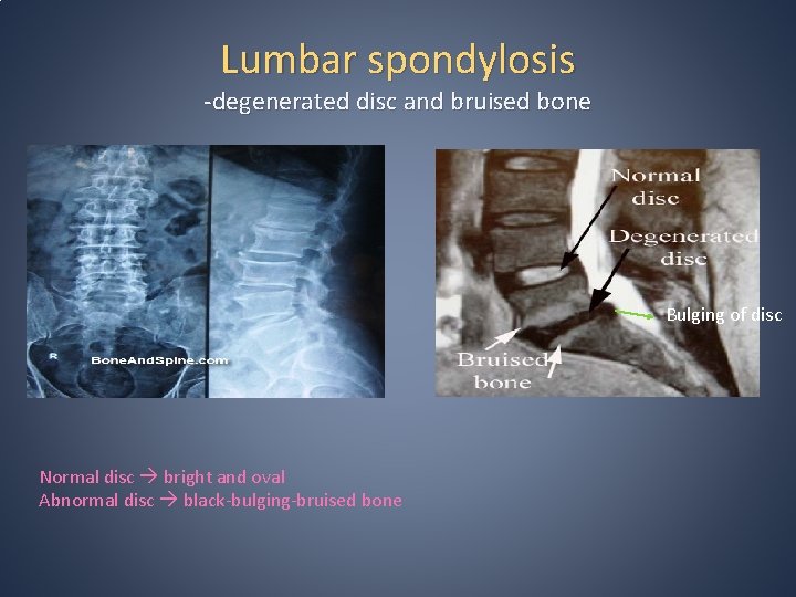 Lumbar spondylosis -degenerated disc and bruised bone Bulging of disc Normal disc bright and Lumbar spondylosis -degenerated disc and bruised bone Bulging of disc Normal disc bright and