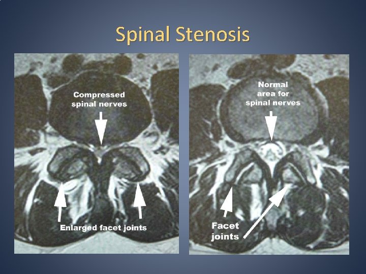 Spinal Stenosis Spinal Stenosis