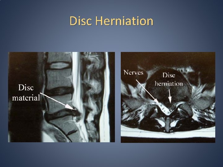 Disc Herniation Disc Herniation