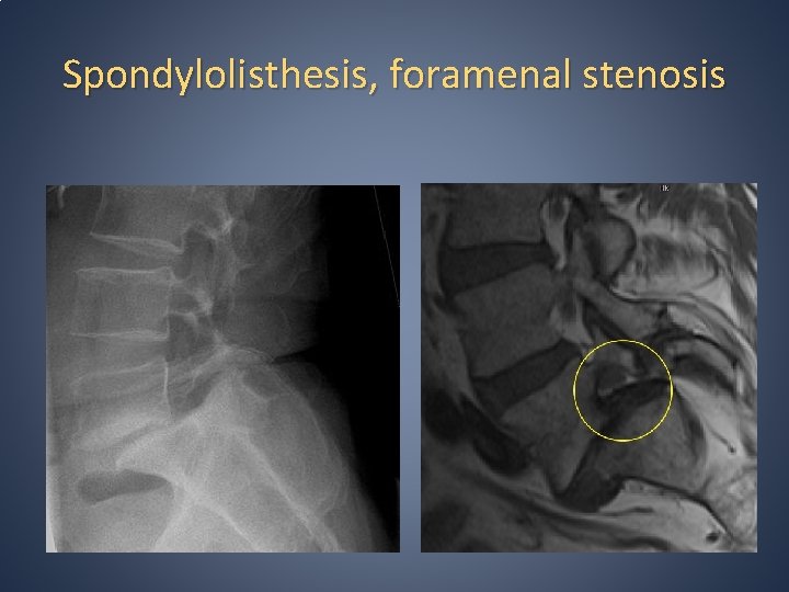 Spondylolisthesis, foramenal stenosis Spondylolisthesis, foramenal stenosis
