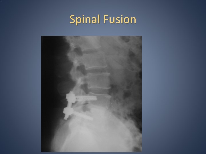 Spinal Fusion Spinal Fusion