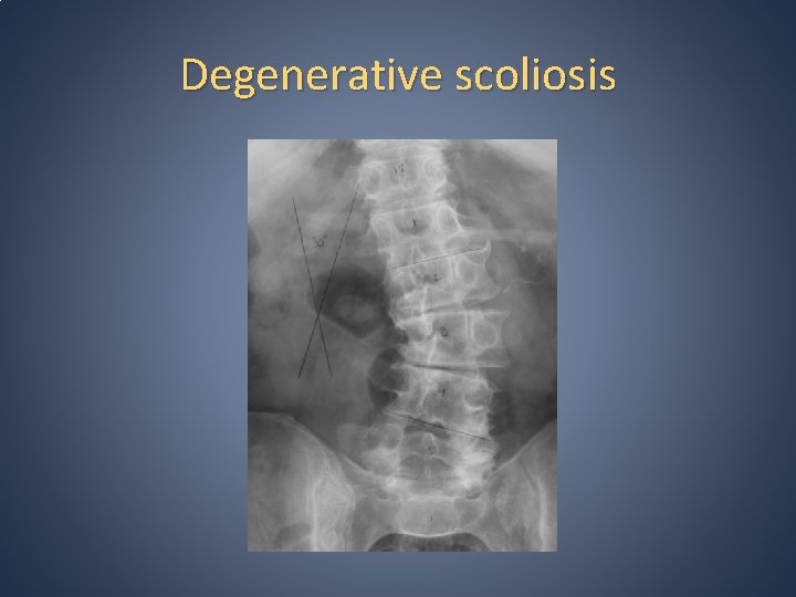 Degenerative scoliosis Degenerative scoliosis