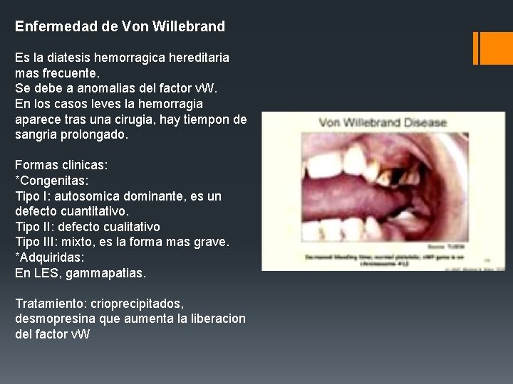 Enfermedad de Von Willebrand Es la diatesis hemorragica hereditaria mas frecuente. Se debe a