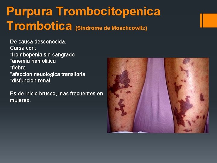 Purpura Trombocitopenica Trombotica (Sindrome de Moschcowitz) De causa desconocida. Cursa con: *trombopenia sin sangrado