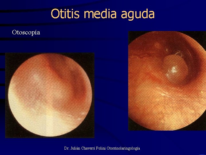 Otitis media aguda Otoscopía Dr. Julián Chaverri Polini Otorrinolaringología 