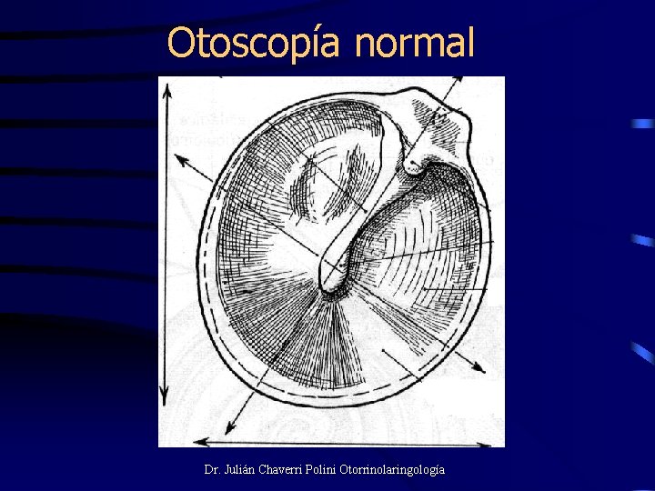 Otoscopía normal Dr. Julián Chaverri Polini Otorrinolaringología 