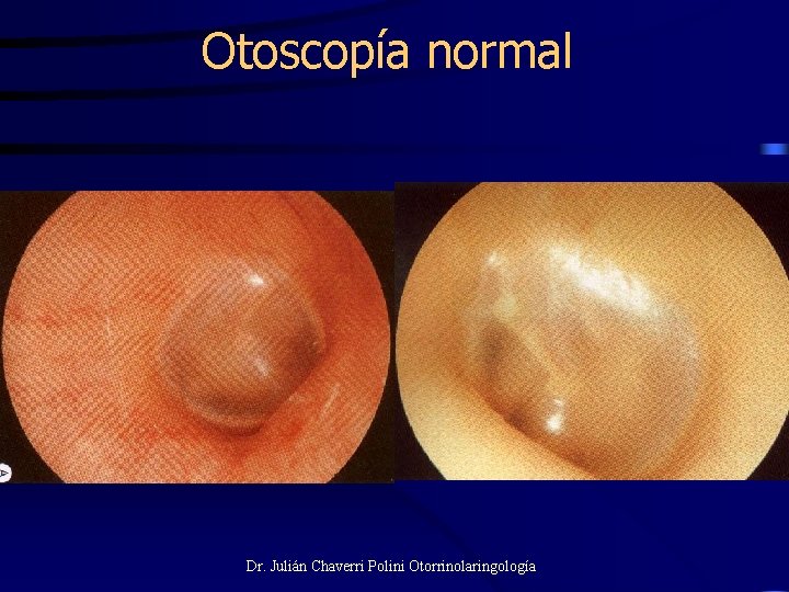 Otoscopía normal Dr. Julián Chaverri Polini Otorrinolaringología 