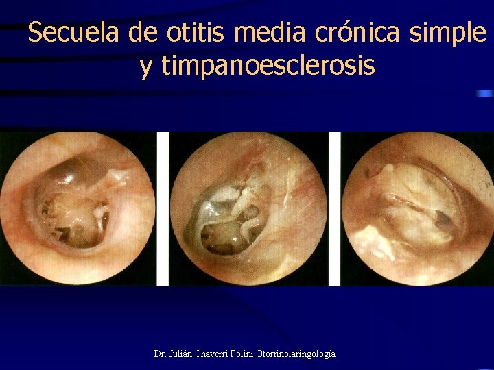 Secuela de otitis media crónica simple y timpanoesclerosis Dr. Julián Chaverri Polini Otorrinolaringología 