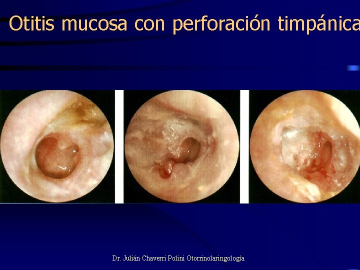 Otitis mucosa con perforación timpánica Dr. Julián Chaverri Polini Otorrinolaringología 