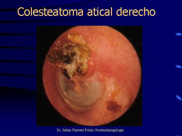 Colesteatoma atical derecho Dr. Julián Chaverri Polini Otorrinolaringología 