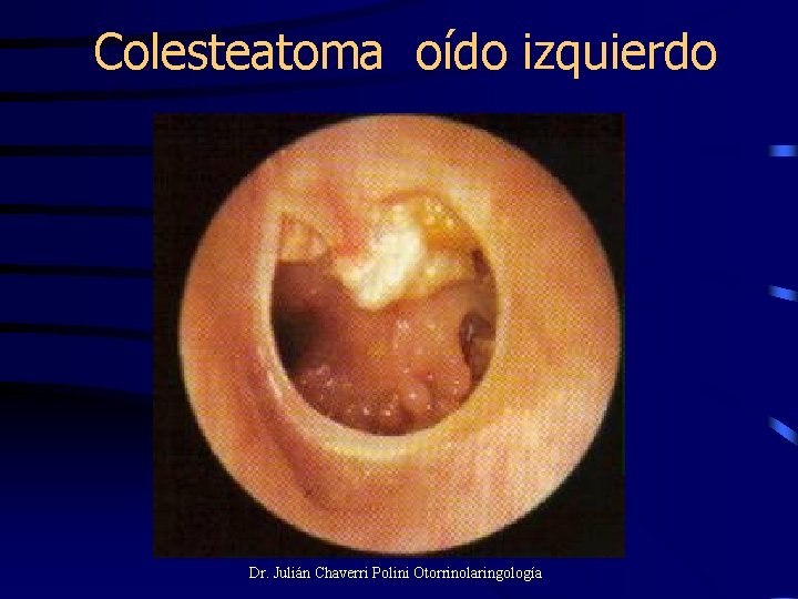 Colesteatoma oído izquierdo Dr. Julián Chaverri Polini Otorrinolaringología 