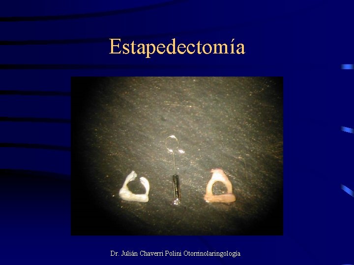 Estapedectomía Dr. Julián Chaverri Polini Otorrinolaringología 