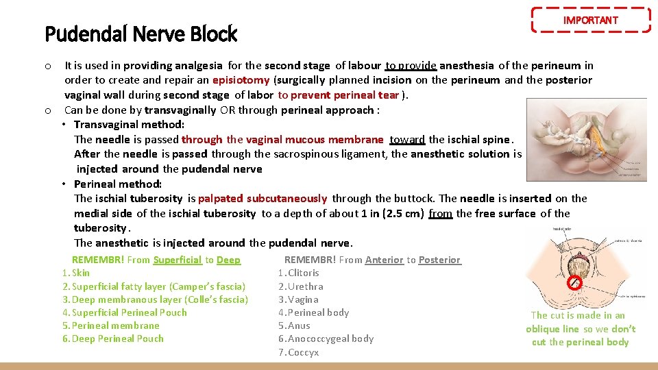 IMPORTANT Pudendal Nerve Block o It is used in providing analgesia for the second