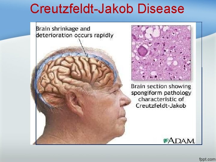 Creutzfeldt-Jakob Disease 