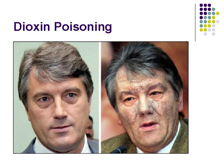 Dioxin Poisoning 