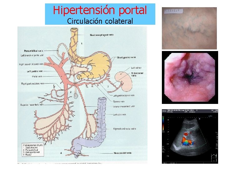 Hipertensión portal Circulación colateral Hipertensión portal Circulación colateral