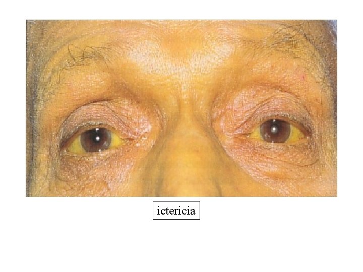 ictericia ictericia