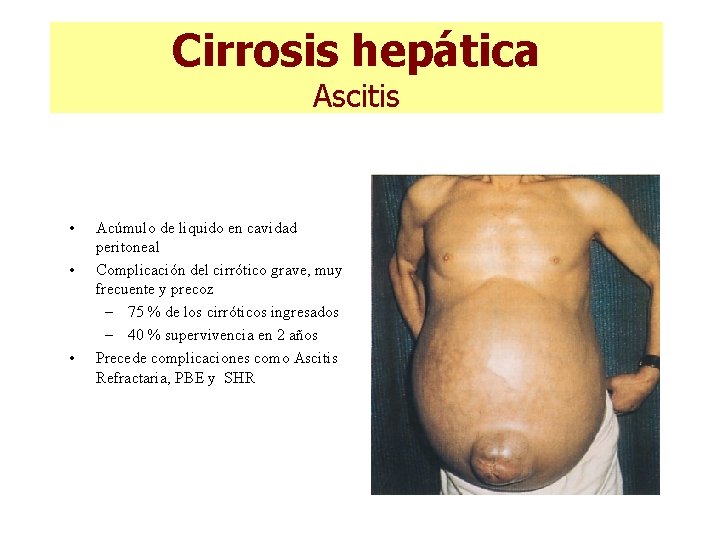 Cirrosis hepática Ascitis • • • Acúmulo de liquido en cavidad peritoneal Complicación del Cirrosis hepática Ascitis • • • Acúmulo de liquido en cavidad peritoneal Complicación del