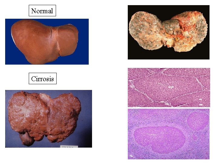 Normal Cirrosis Normal Cirrosis