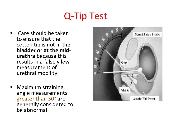 Q-Tip Test • Care should be taken to ensure that the cotton tip is