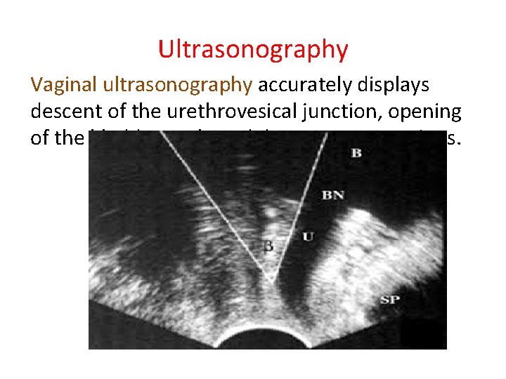 Ultrasonography Vaginal ultrasonography accurately displays descent of the urethrovesical junction, opening of the bladder