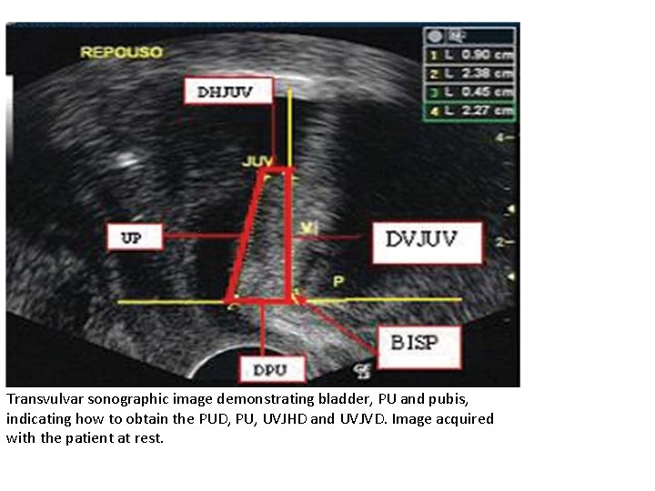 Transvulvar sonographic image demonstrating bladder, PU and pubis, indicating how to obtain the PUD,