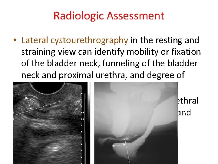 Radiologic Assessment • Lateral cystourethrography in the resting and straining view can identify mobility