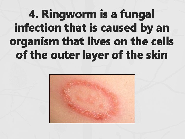 4. Ringworm is a fungal infection that is caused by an organism that lives 4. Ringworm is a fungal infection that is caused by an organism that lives