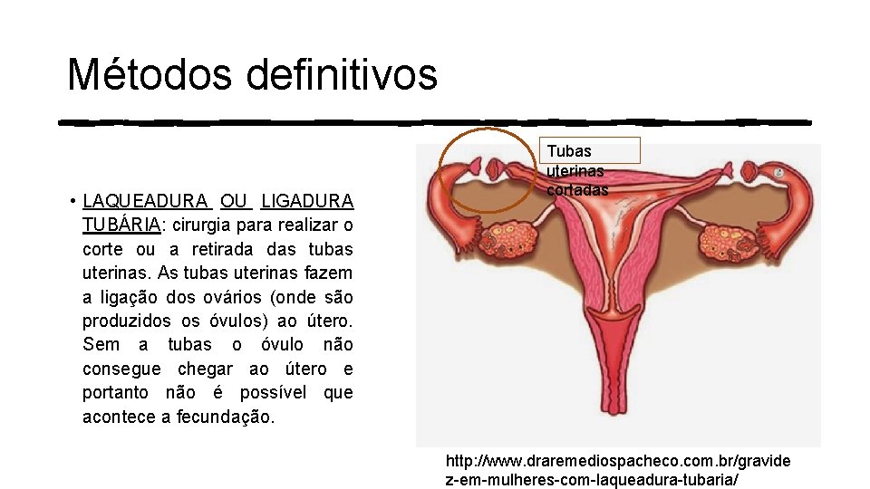 Métodos definitivos • LAQUEADURA OU LIGADURA TUBÁRIA: cirurgia para realizar o corte ou a Métodos definitivos • LAQUEADURA OU LIGADURA TUBÁRIA: cirurgia para realizar o corte ou a