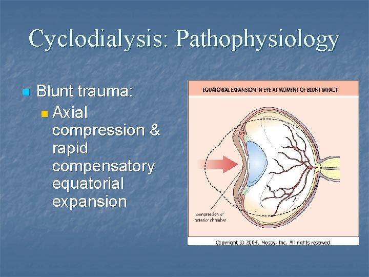 Cyclodialysis: Pathophysiology n Blunt trauma: n Axial compression & rapid compensatory equatorial expansion 