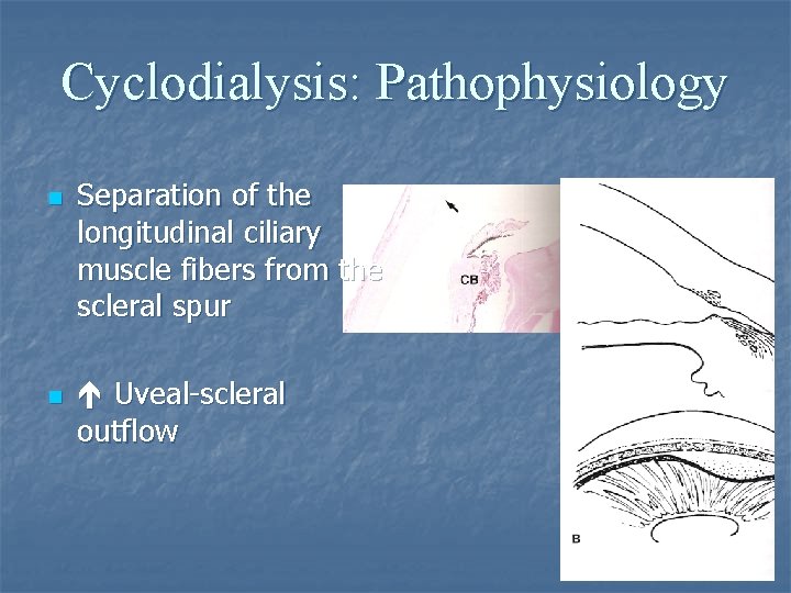 Cyclodialysis: Pathophysiology n n Separation of the longitudinal ciliary muscle fibers from the scleral