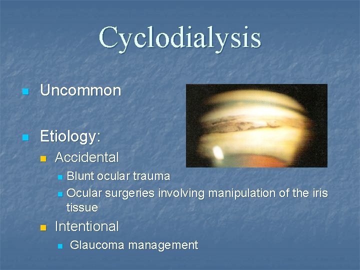 Cyclodialysis n Uncommon n Etiology: n Accidental Blunt ocular trauma n Ocular surgeries involving