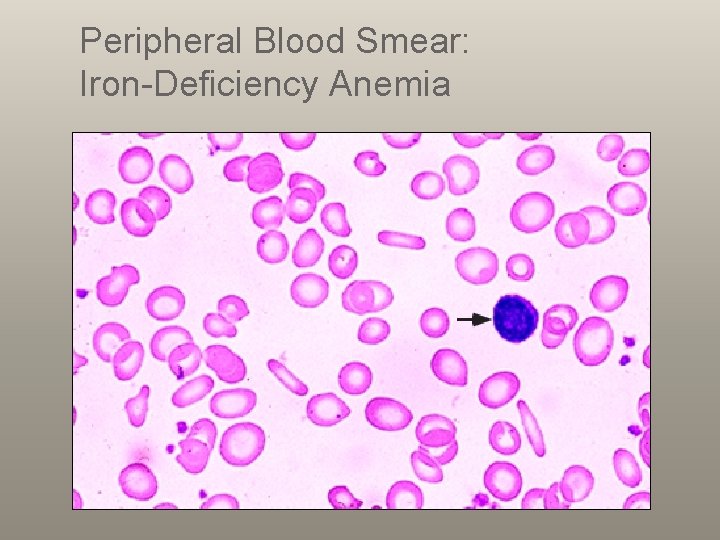 Peripheral Blood Smear: Iron-Deficiency Anemia 