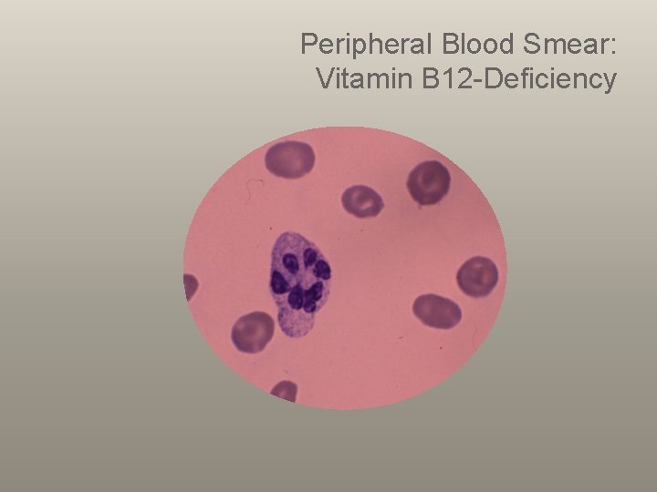 Peripheral Blood Smear: Vitamin B 12 -Deficiency 