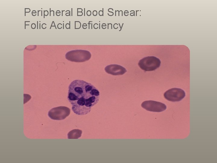 Peripheral Blood Smear: Folic Acid Deficiency 