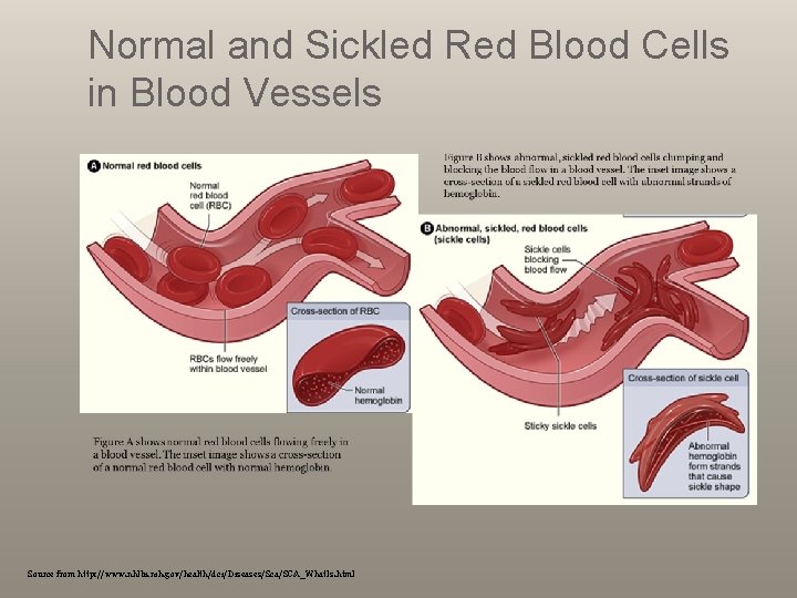 Normal and Sickled Red Blood Cells in Blood Vessels Source from http: //www. nhlbi.