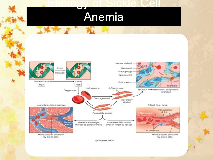 Etiology of Sickle Cell Anemia 