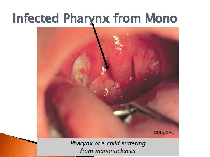 Infected Pharynx from Mono 