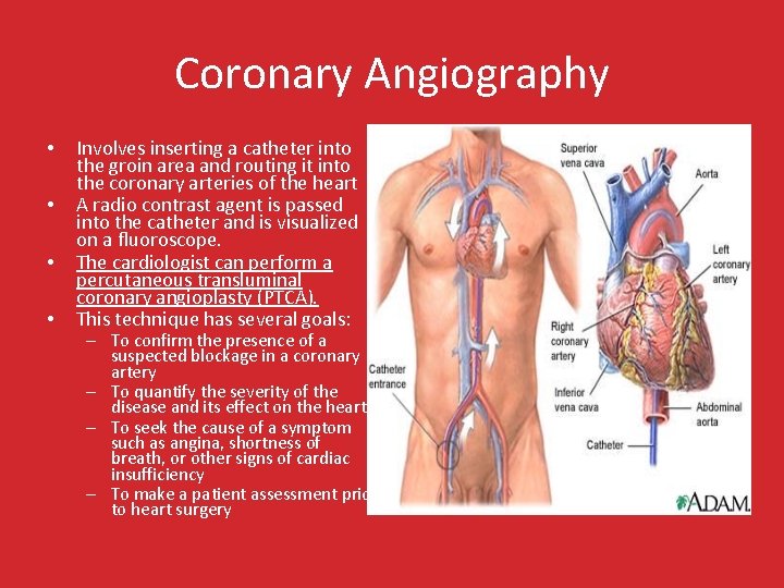 Coronary Angiography • • Involves inserting a catheter into the groin area and routing
