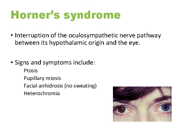 Horner’s syndrome • Interruption of the oculosympathetic nerve pathway between its hypothalamic origin and