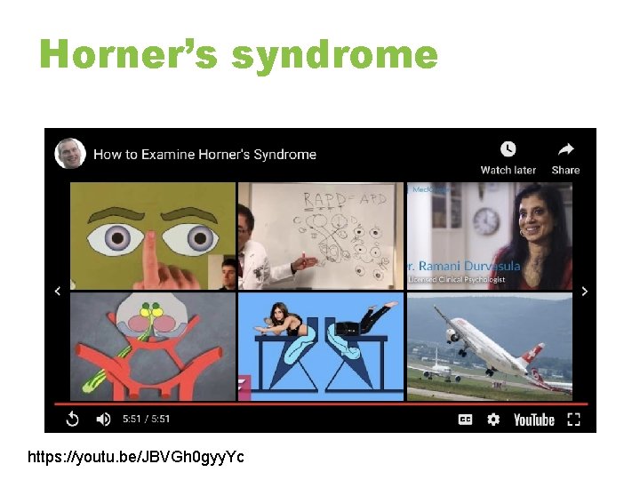 Horner’s syndrome https: //youtu. be/JBVGh 0 gyy. Yc 