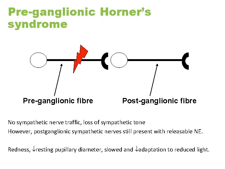 Pre-ganglionic Horner’s syndrome Pre-ganglionic fibre Post-ganglionic fibre No sympathetic nerve traffic, loss of sympathetic