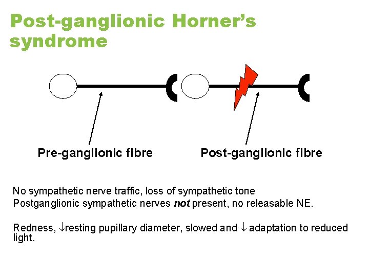 Post-ganglionic Horner’s syndrome Pre-ganglionic fibre Post-ganglionic fibre No sympathetic nerve traffic, loss of sympathetic