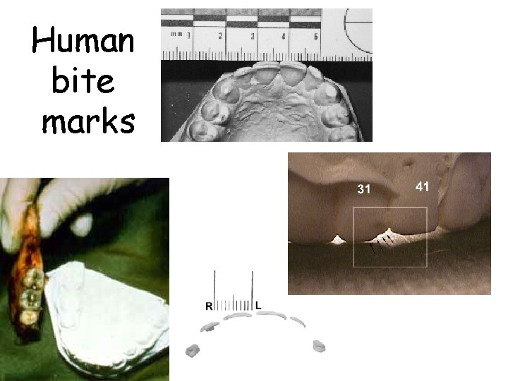 Human bite marks 