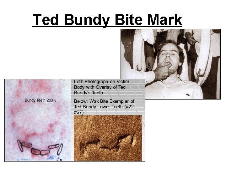 Ted Bundy Bite Mark 