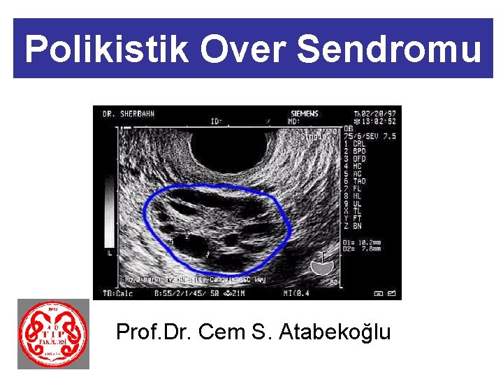Polikistik Over Sendromu Prof. Dr. Cem S. Atabekoğlu 