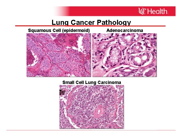 Lung Cancer Pathology Squamous Cell (epidermoid) Adenocarcinoma Small Cell Lung Carcinoma 
