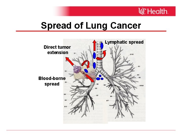 Spread of Lung Cancer Direct tumor extension Blood-borne spread Lymphatic spread 